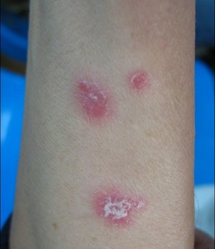 患者的小腿上出现红斑是否是牛皮癣症状